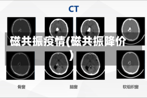 磁共振疫情(磁共振降价)