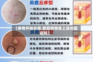 【疫情开始长痘,新冠疫情身上会长痘痘吗】
