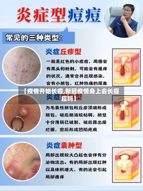 【疫情开始长痘,新冠疫情身上会长痘痘吗】-第1张图片
