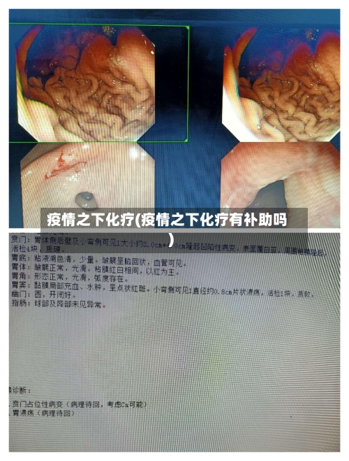 疫情之下化疗(疫情之下化疗有补助吗)-第1张图片